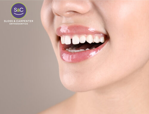 Revolutionizing Smiles: The Artful Transformation of Diastema or Gap Teeth with Invisalign Magic