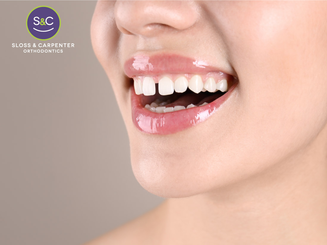 You can use Invisalign clear aligners to correct your dental alignment and fix a case of gap teeth.